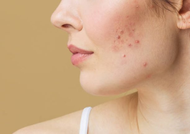 Young woman before and after acne treatment. Skin care concept