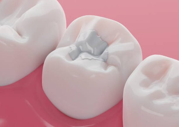 Teeth white composite filling, Decay and broken teeth treatment concept. 3D rendering.