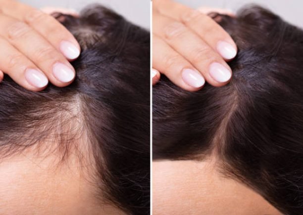 Woman Before And After Hair Loss Treatment