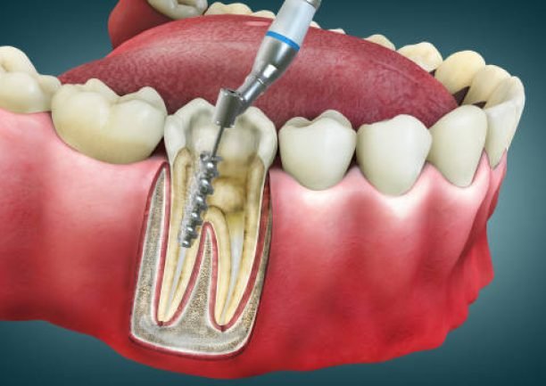 4D Root Canal Image