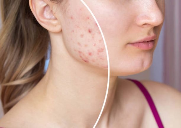 Cropped shot of a young woman's face before and after acne treatment. Pimples, red scars on the girl's cheeks. Problem skin, care and beauty concept. Dermatology, cosmetology. Result of a therapy