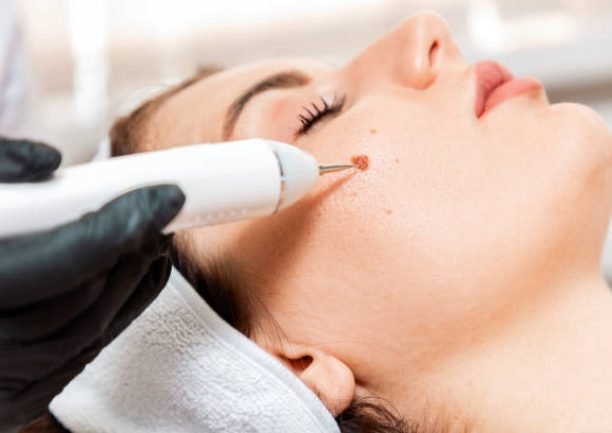 Professional salon procedures. Surgeon using a laser device for removing mole. Removal of birthmark from female face. Close up. Concept of laser cosmelotogy and electrocoagulation.